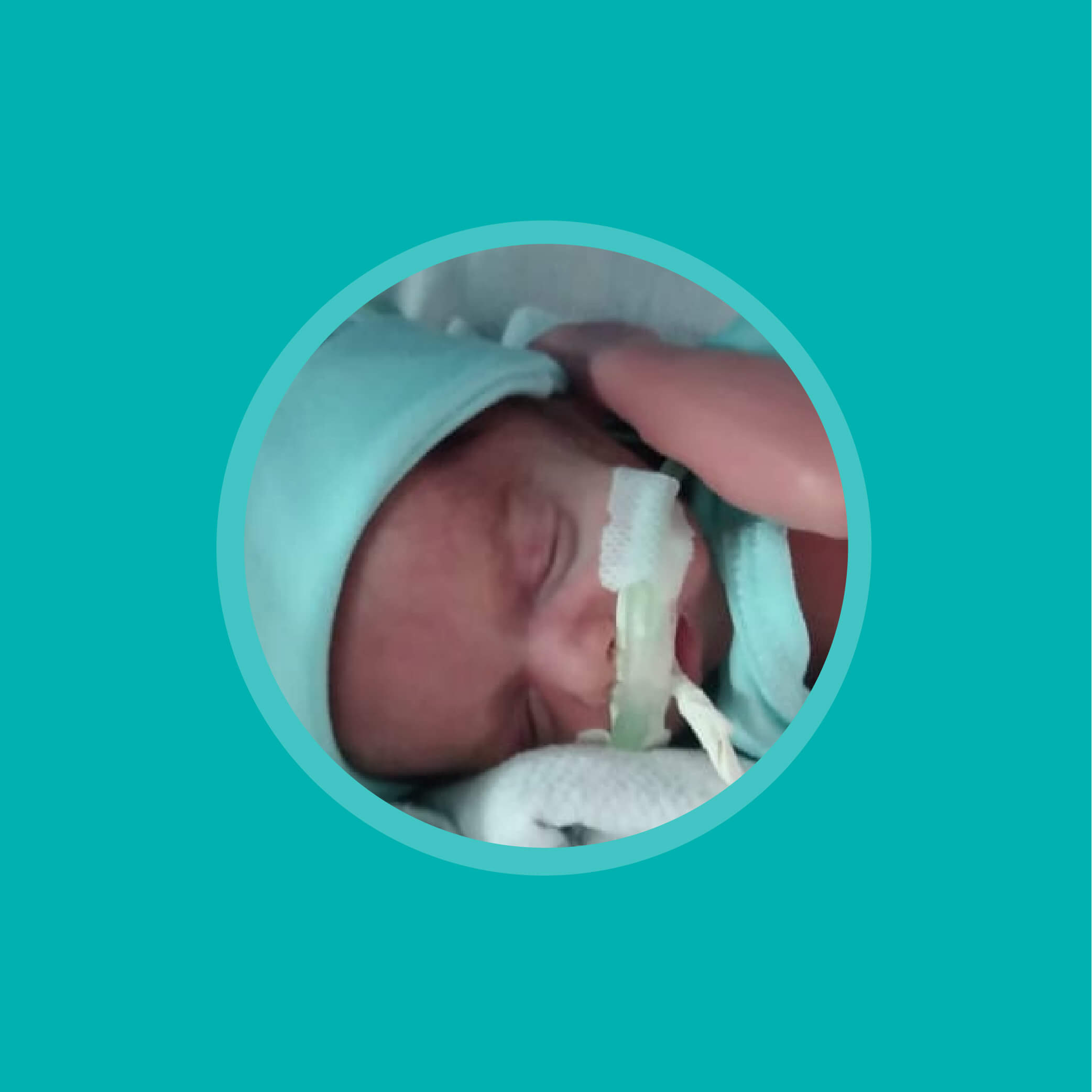 Lee más sobre el artículo Resultados hospitalarios y de desarrollo neurológico en bebés prematuros que reciben ventilación invasiva frente a no invasiva al nacer
